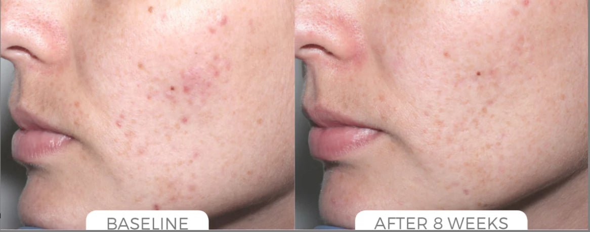Acne Control System