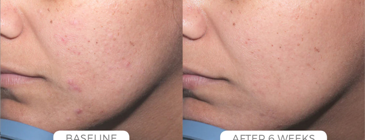 Acne Control System
