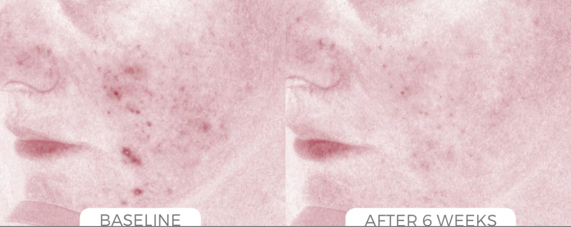 Acne Control System